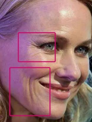 Treat Fine Lines and Wrinkles