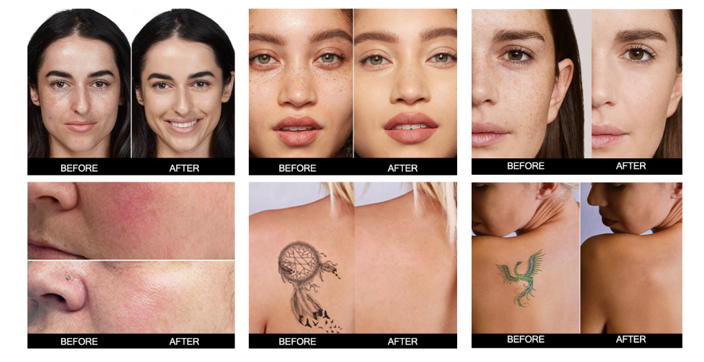 Lav Dual 1927nm + 1550nm Thulium Laser 12 Lav Dual 1927nm + 1550nm Thulium Laser | Cocoon Laser | 1 13 1