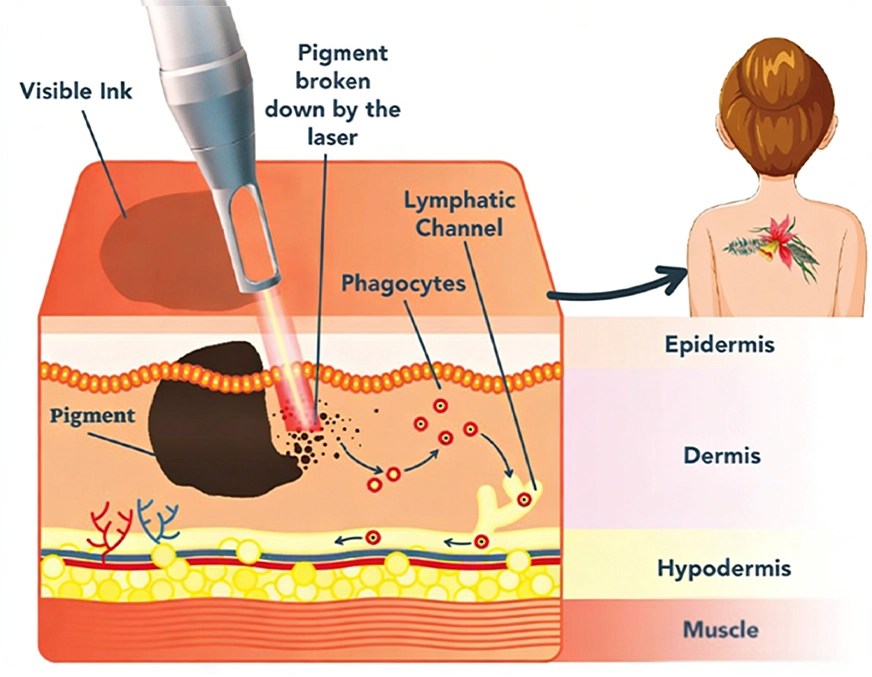 I-Cool Pico PURE | Cocoon Laser | 5 1