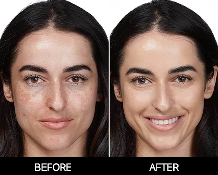 I-Cool Pico PURE | Cocoon Laser | 8 1