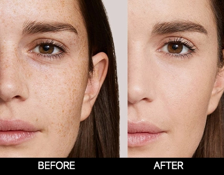 I-Cool Pico PURE | Cocoon Laser | 8 3