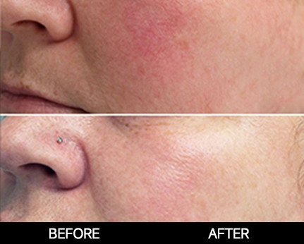 I-Cool Pico PURE | Cocoon Laser | 8 4