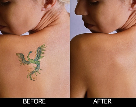 I-Cool Pico PURE | Cocoon Laser | 8 6