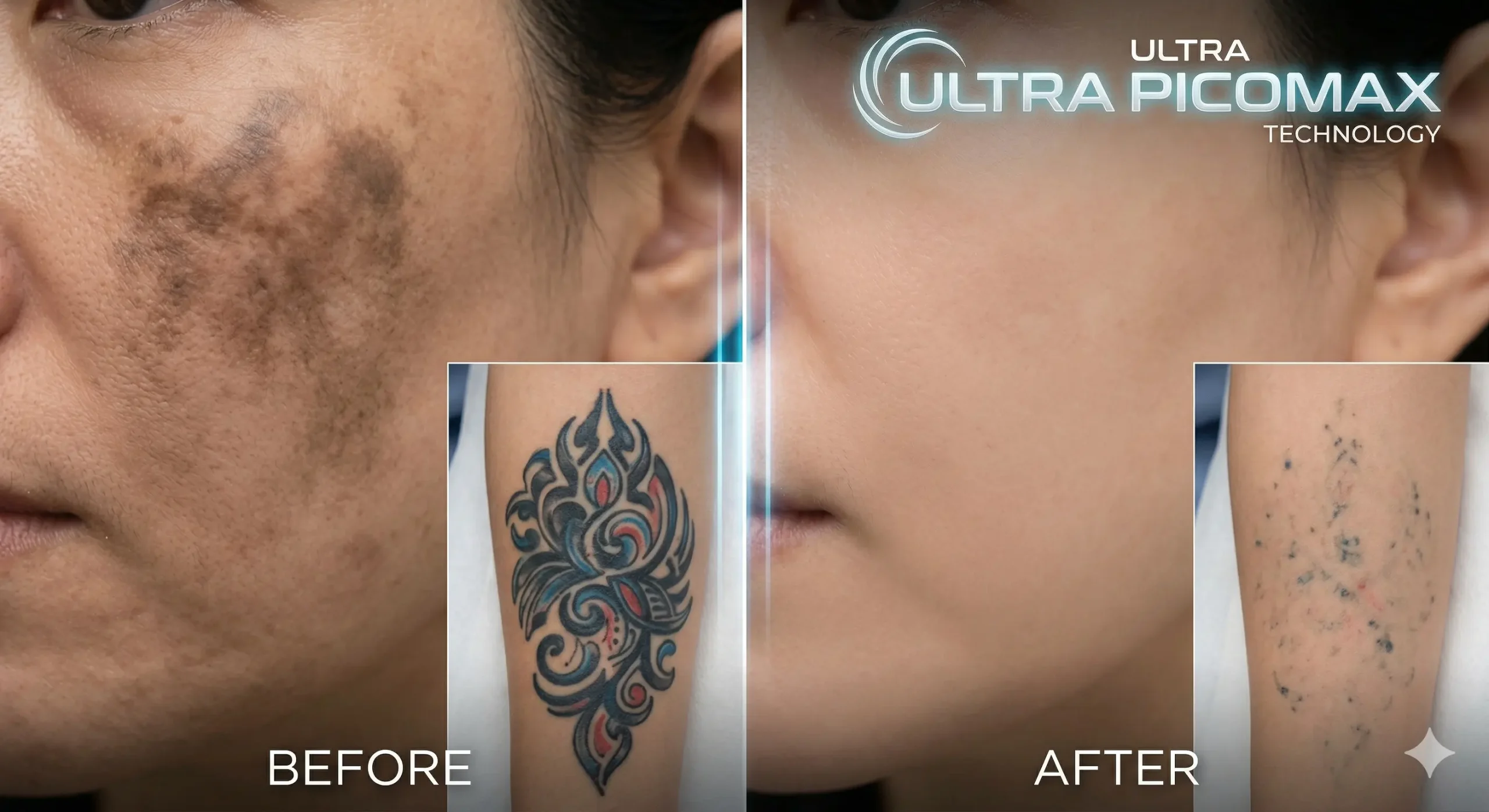 Unveiling the Power of Ultra PicoMax: The Future of Advanced Skin Rejuvenation 2 Ultra PicoMax laser before and after tattoo removal and pigmentation