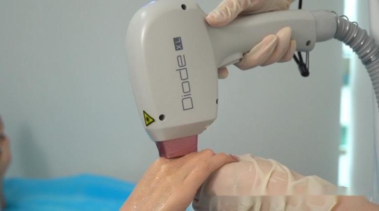 Best 810nm Diode Laser Hair Removal at Home (2026 Guide)
