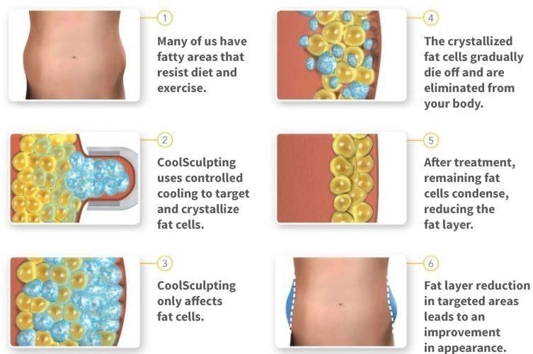 What Is Body Contouring? Complete Guide to Non-Surgical Body Contouring 5 Non-surgical fat reduction body contouring treatment concept