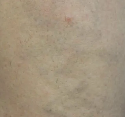 After picosecond laser tattoo removal treatment result