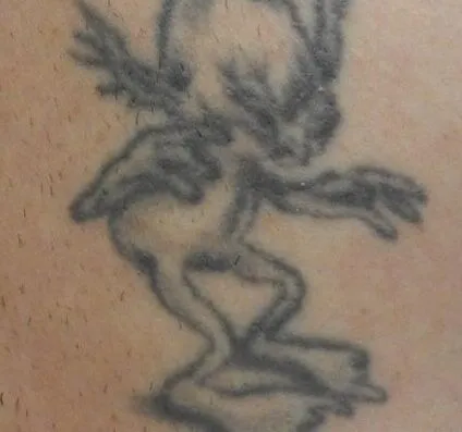 Before picosecond laser tattoo removal treatment