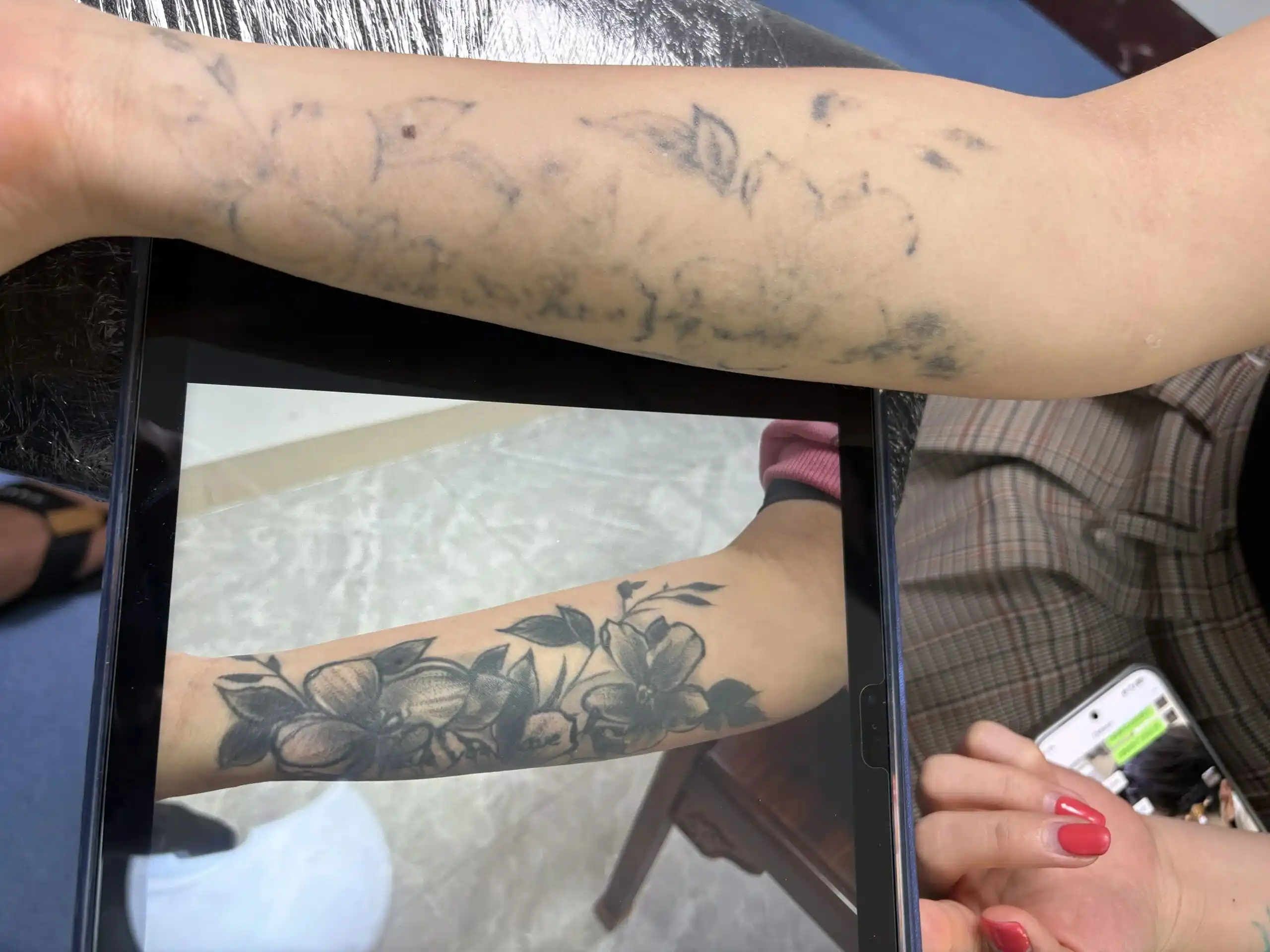 Picosecond Laser Tattoo Removal Technology: How Pico Lasers Remove Tattoos | Cocoon Laser | picosecond laser tattoo removal