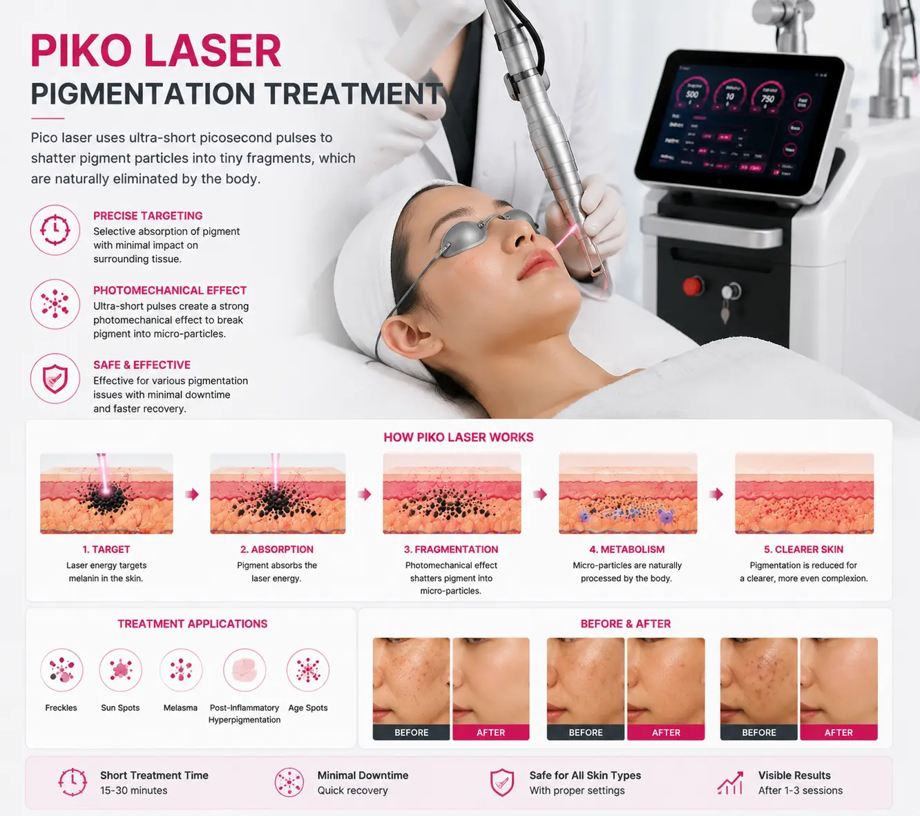 Piko laser pigmentation treatment technology