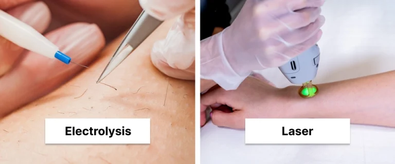 Laser Hair Removal vs Electrolysis: Complete Guide for Clinics
