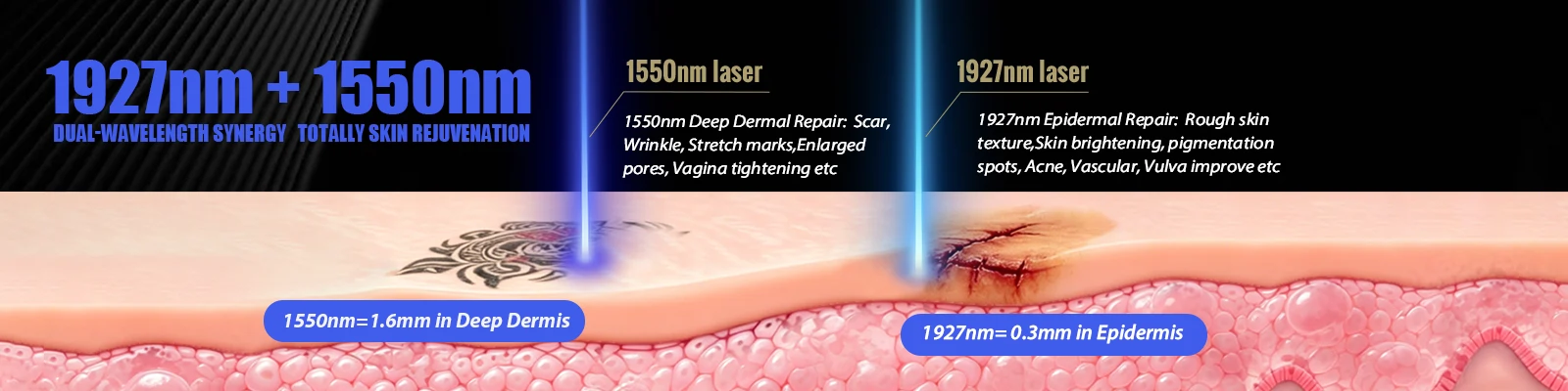 Thulium laser technology using 1927nm and 1550nm wavelengths for aesthetic treatments