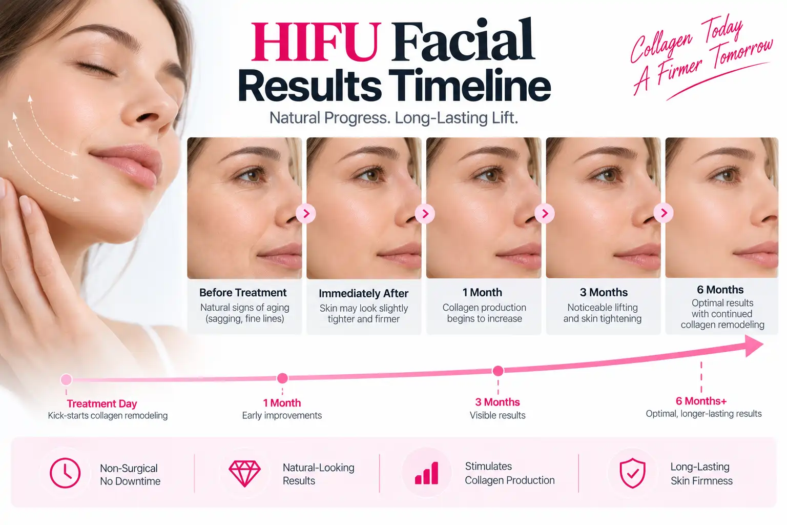 HIFU facial results timeline showing gradual skin tightening and collagen remodeling