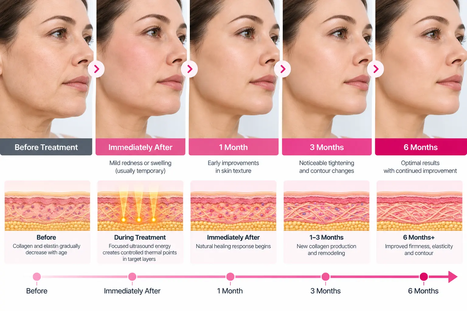 HIFU treatment before and after results timeline from immediately after treatment to six months