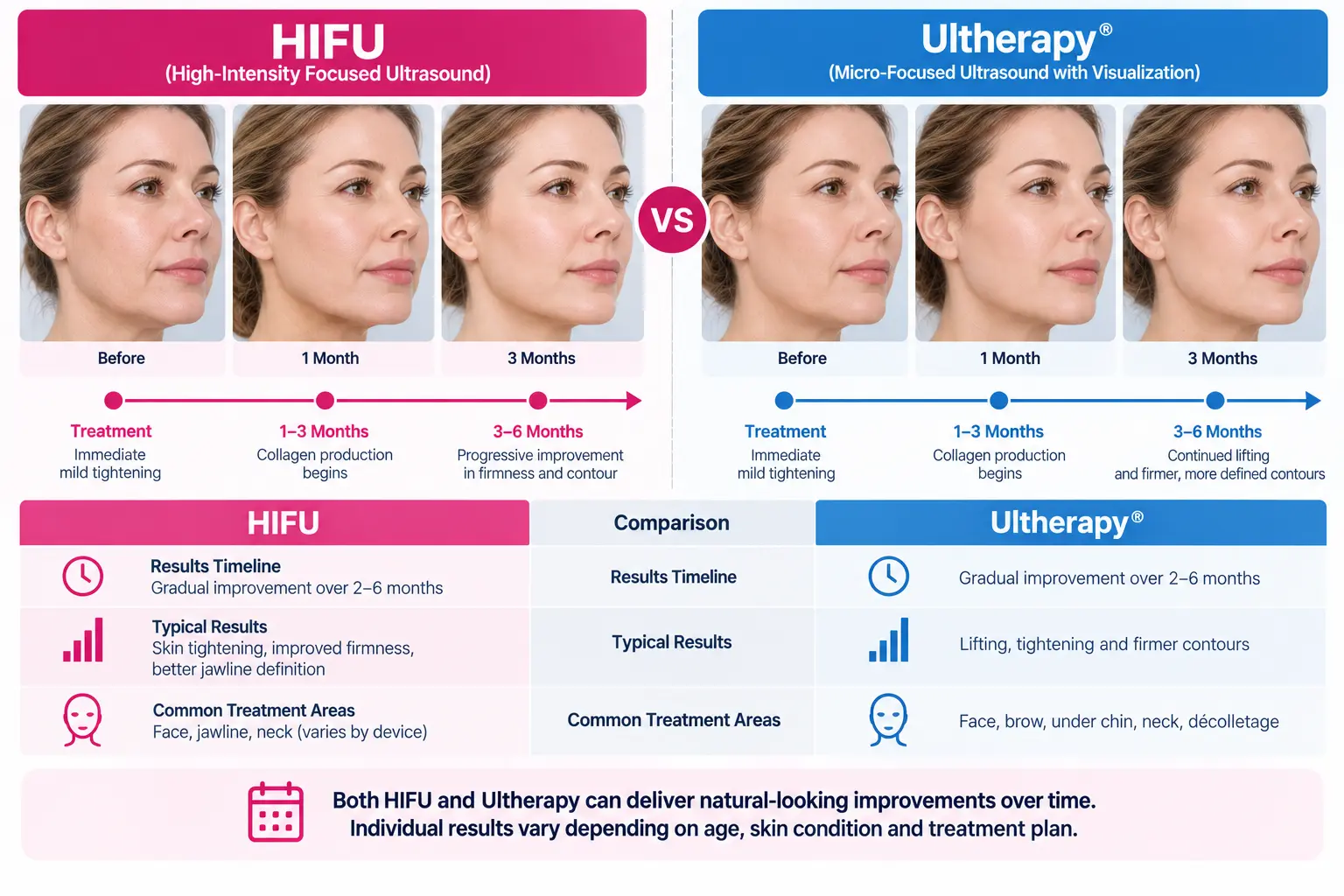 HIFU vs Ultherapy results and treatment timeline comparison