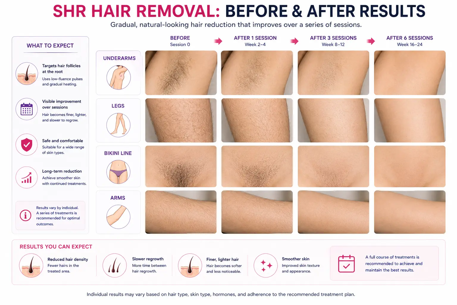 SHR hair removal before and after results showing gradual hair reduction