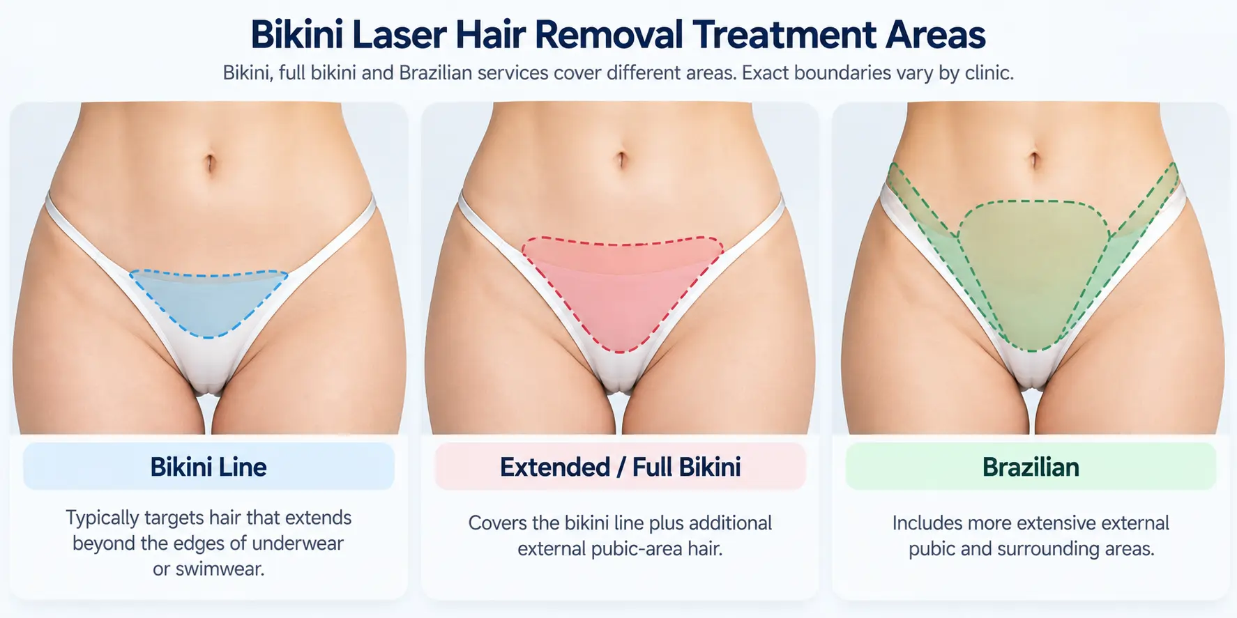 Educational diagram showing general bikini line, extended bikini and Brazilian laser hair removal treatment boundaries