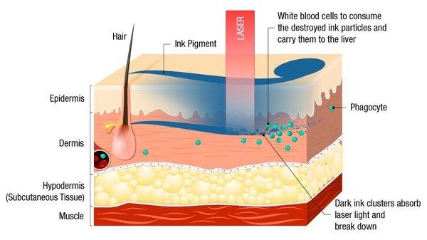 Medical illustration explaining how picosecond laser pulses interact with tattoo ink particles in the dermis