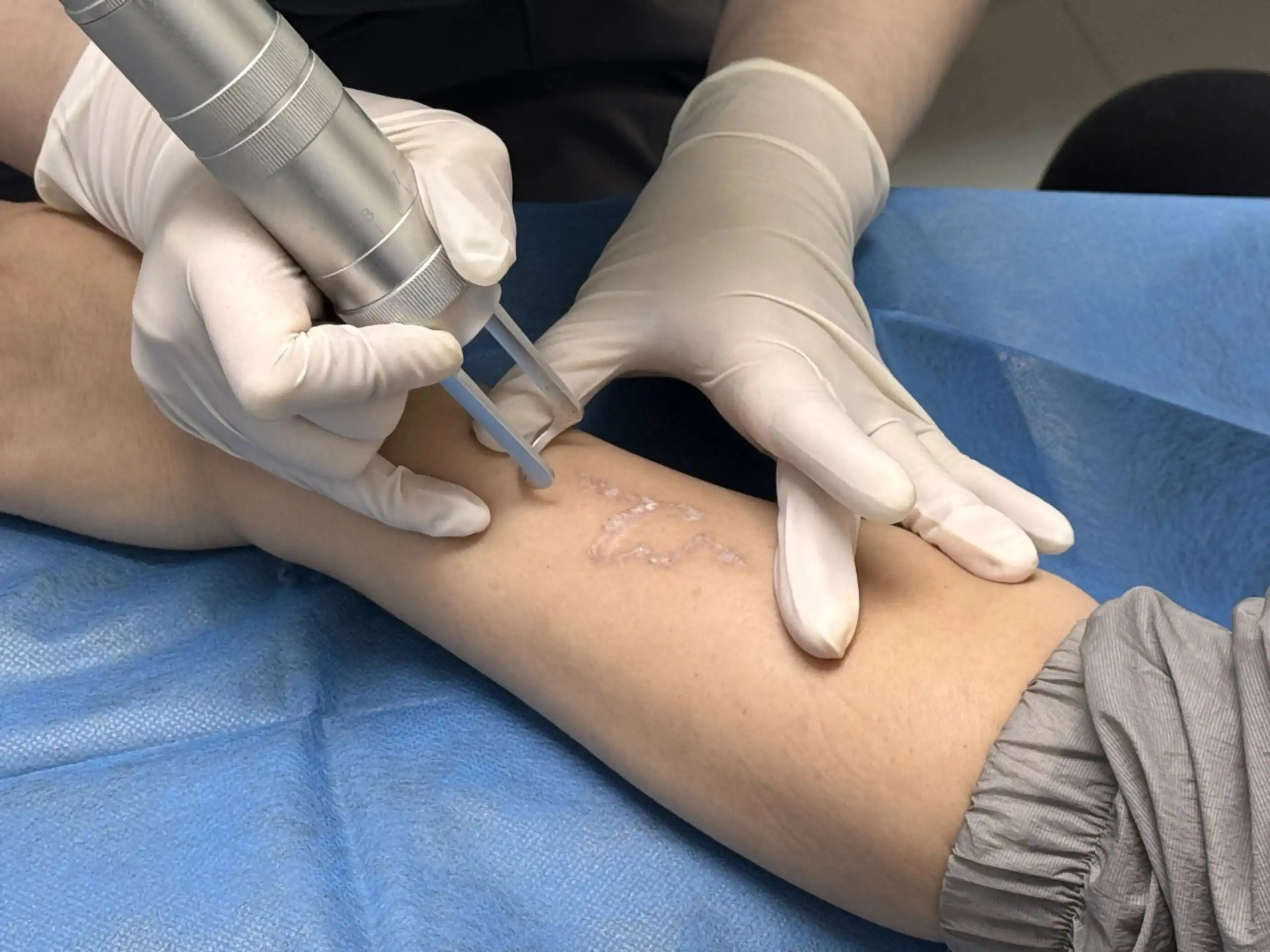 Clinical tattoo removal progress photography illustrating changes across multiple treatment sessions