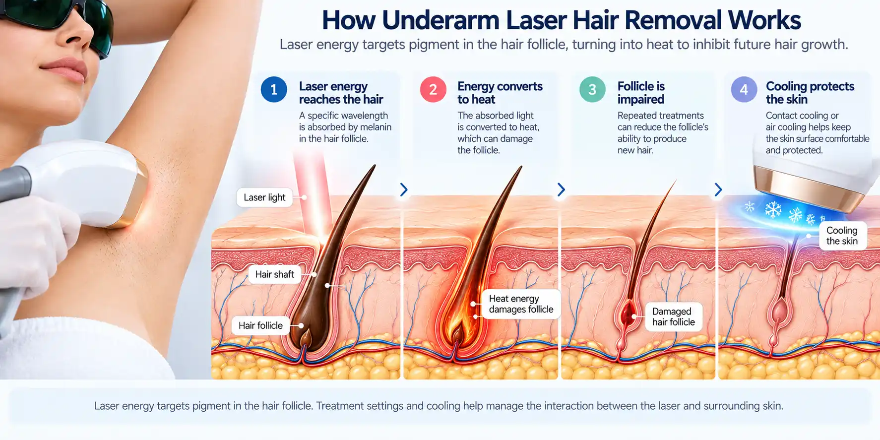 Medical illustration showing laser energy targeting a pigmented underarm hair follicle while cooling protects the skin surface